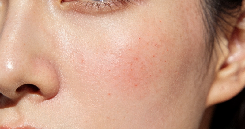 Strengthen Skin Barrier